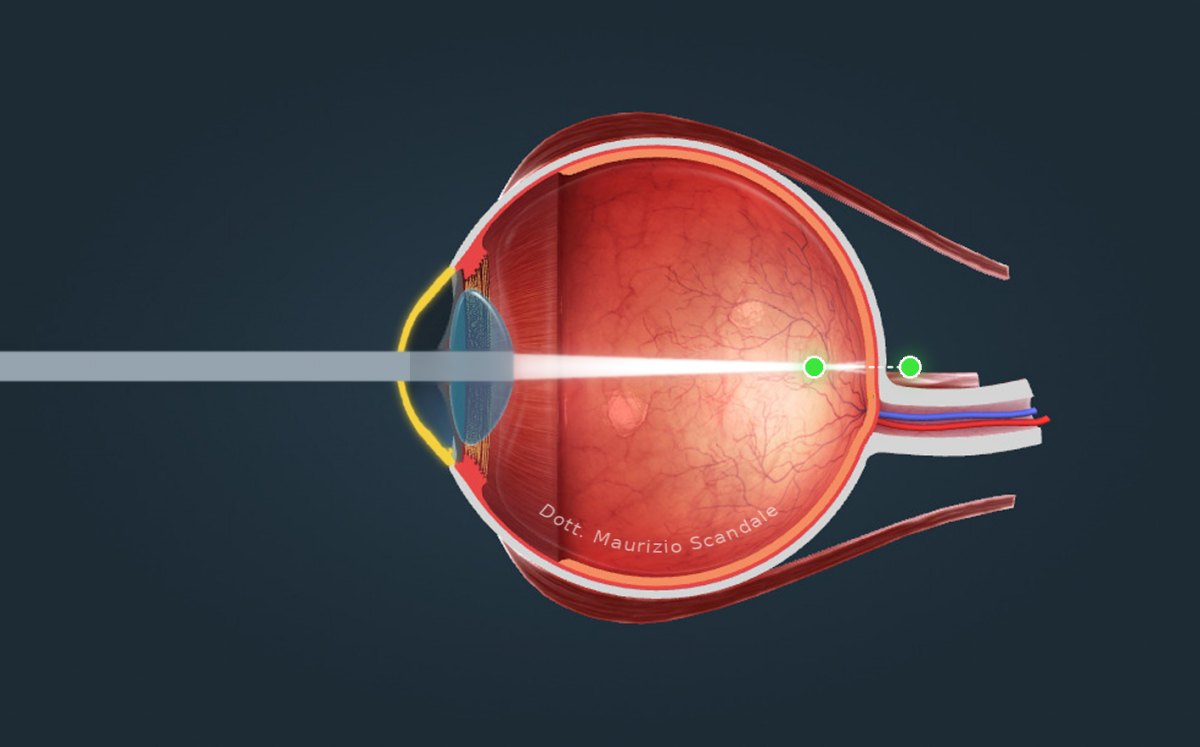 Astigmatismo: cornea con curvatura irregolare, due punti di fuoco