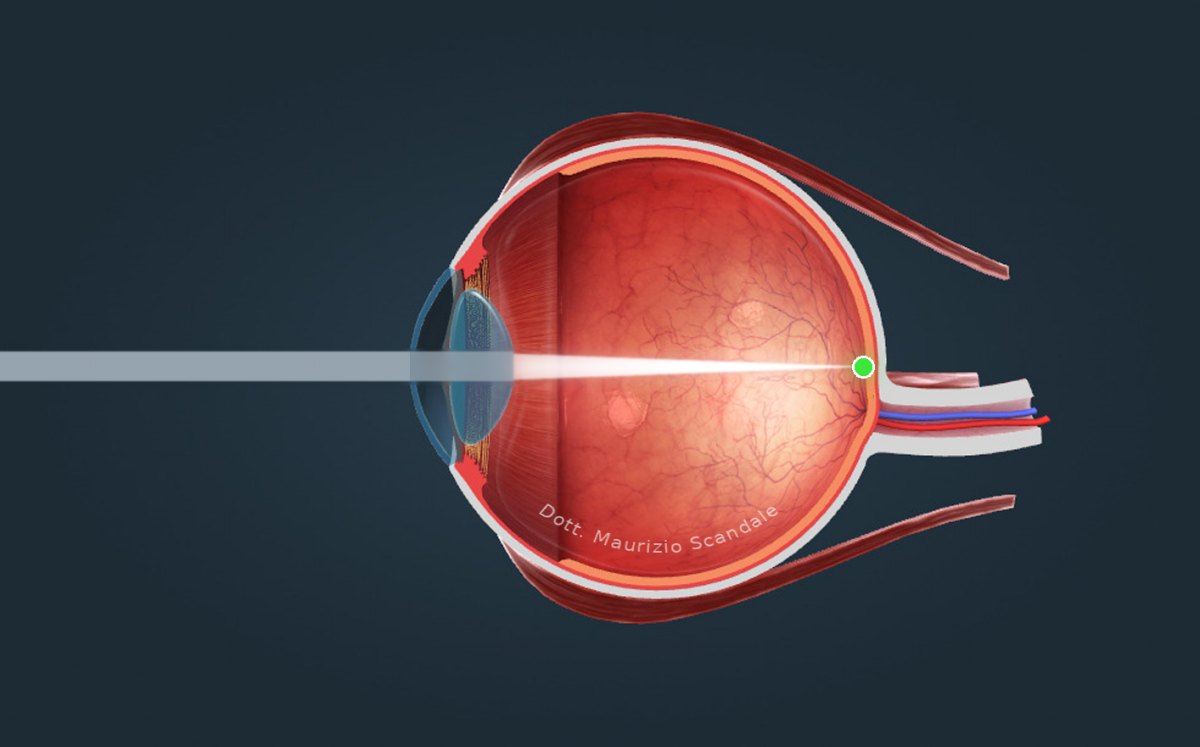 Occhio emmetrope: la luce va a fuoco sulla retina