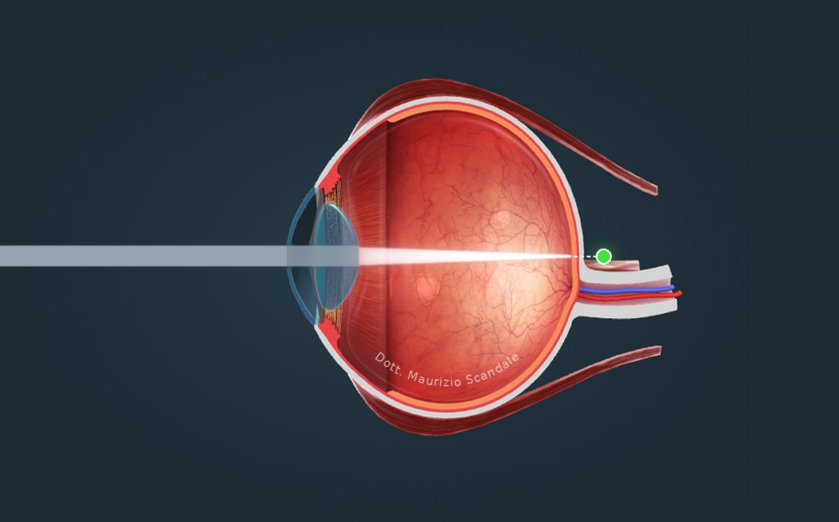 Ipermetropia: occhio corto, la luce va a fuoco dietro la retina