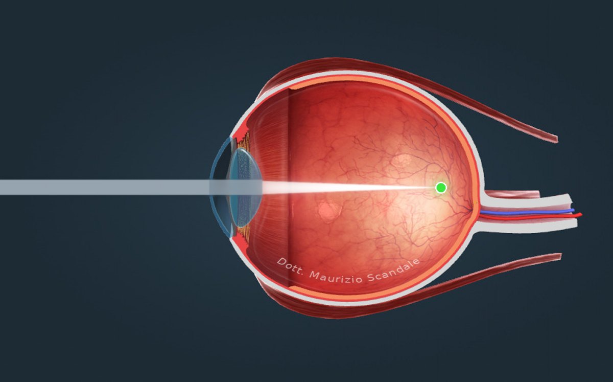 Miopia: occhio lungo, la luce va a fuoco davanti alla retina